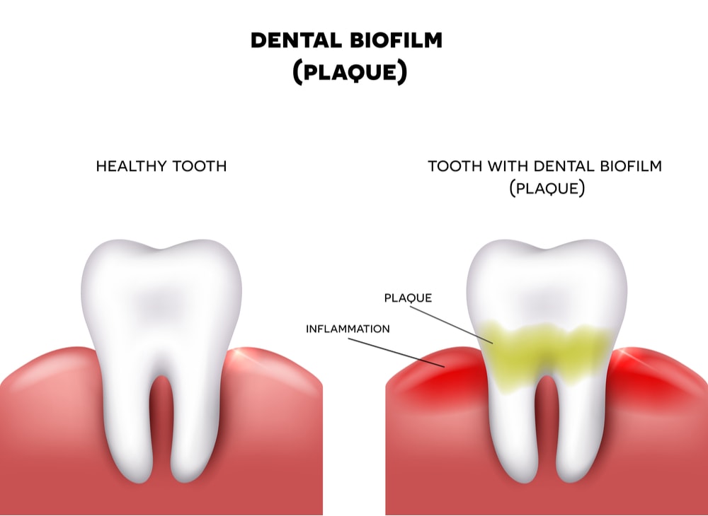 Dental plaque and gum inflammation