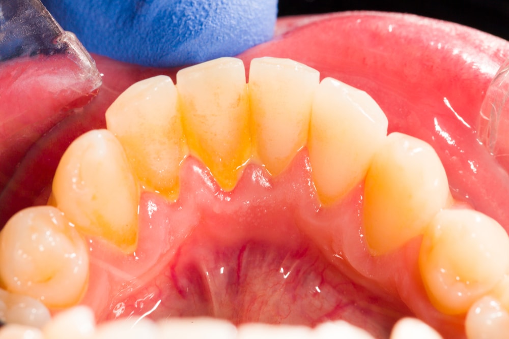 Yellow calculus and plaque on teeth