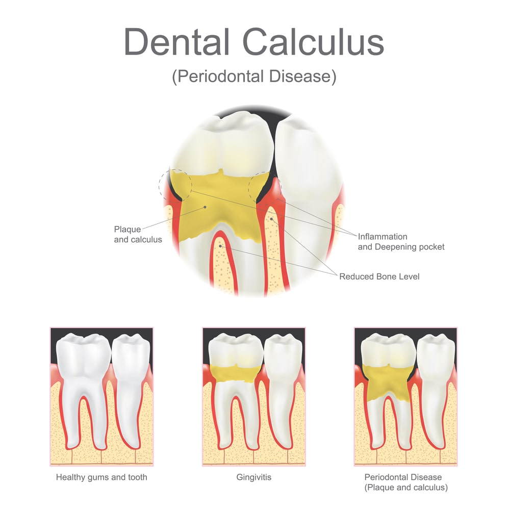 How calculus can lead to gingivitis and finally periodontal disease