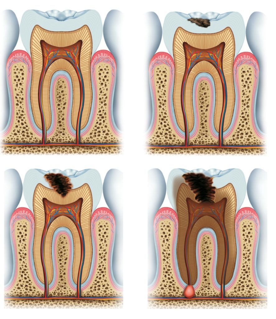 Gradual process of tooth cavity formation