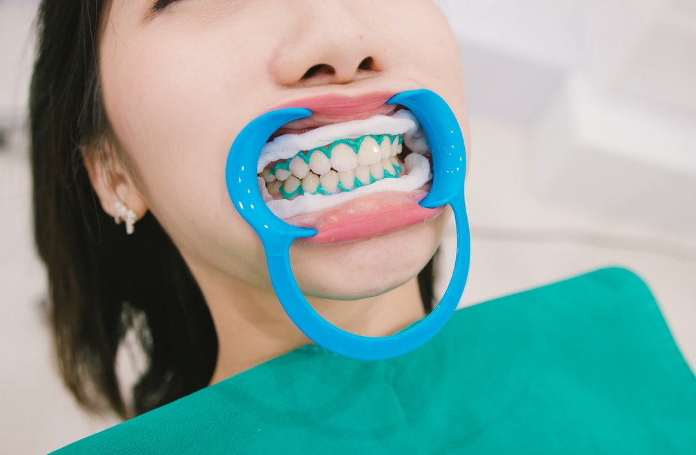 Patient with cheek retractors during in-office teeth whitening. Gums are protected.