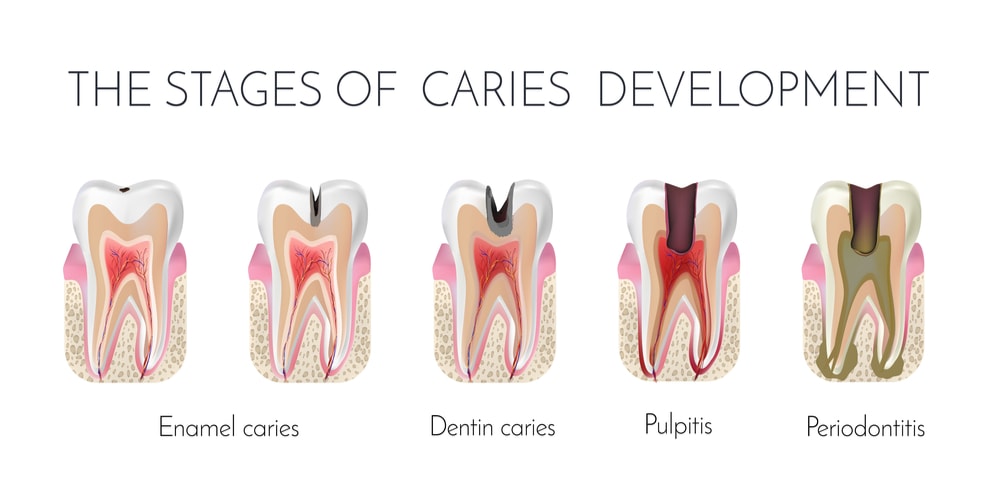 Stages of caries formation: enamel caries, dentin caries, pulpitis and periodontitis