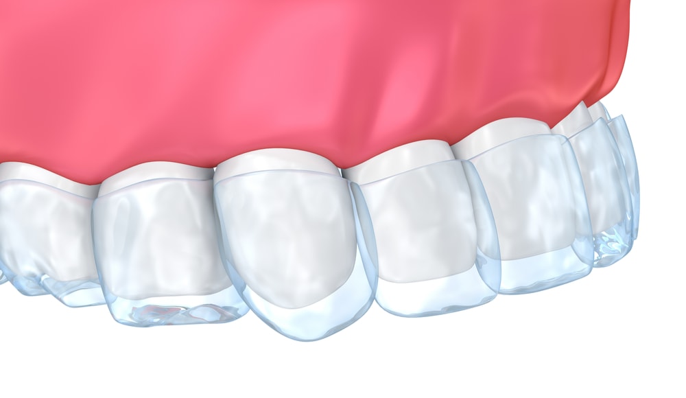 Teeth whitening trays fitting onto teeth