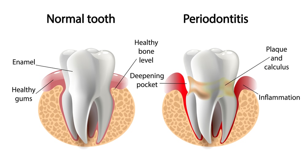 Normal tooth and tooth with gum disease (periodontitis)