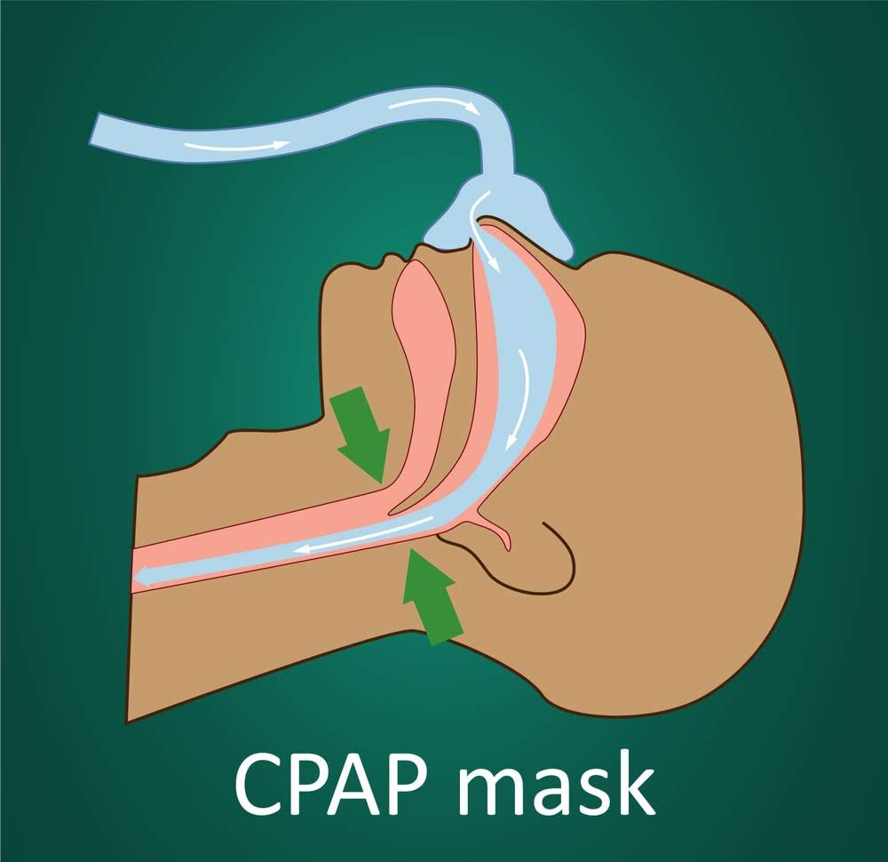 Image showing unoccluded airflow when wearing a continuous positive airway pressure (CPAP) mask
