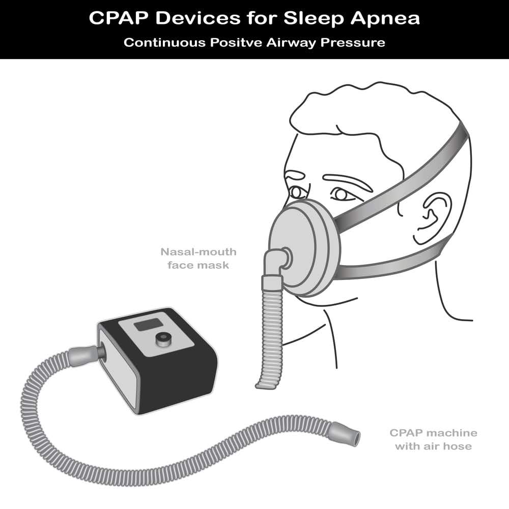 Image of a continuous positive air pressure machine showing nasal-mouth mask and air hose