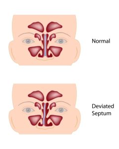 Image comparing a straight and a deviated nasal septa.