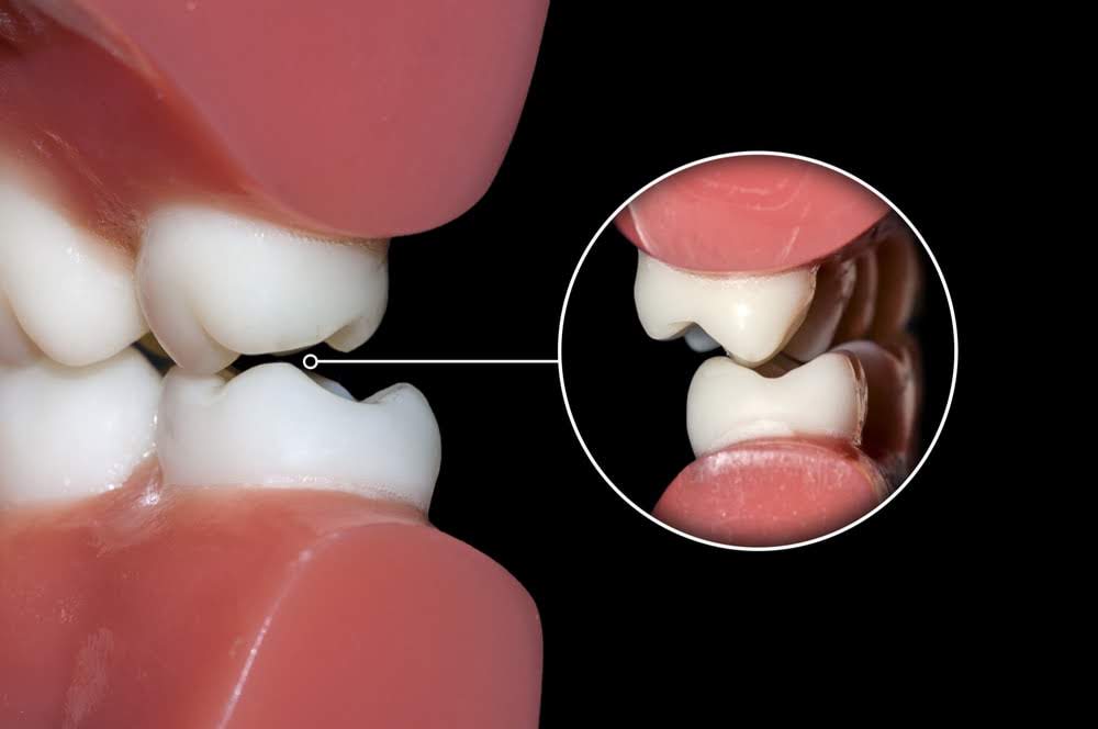 Close-up of molars showing malocclusion