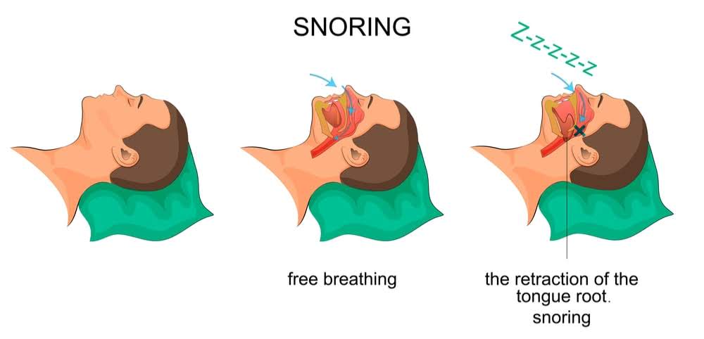 Comparison of the flow of air when breathing freely and when snoring due to the tongue's root retracting