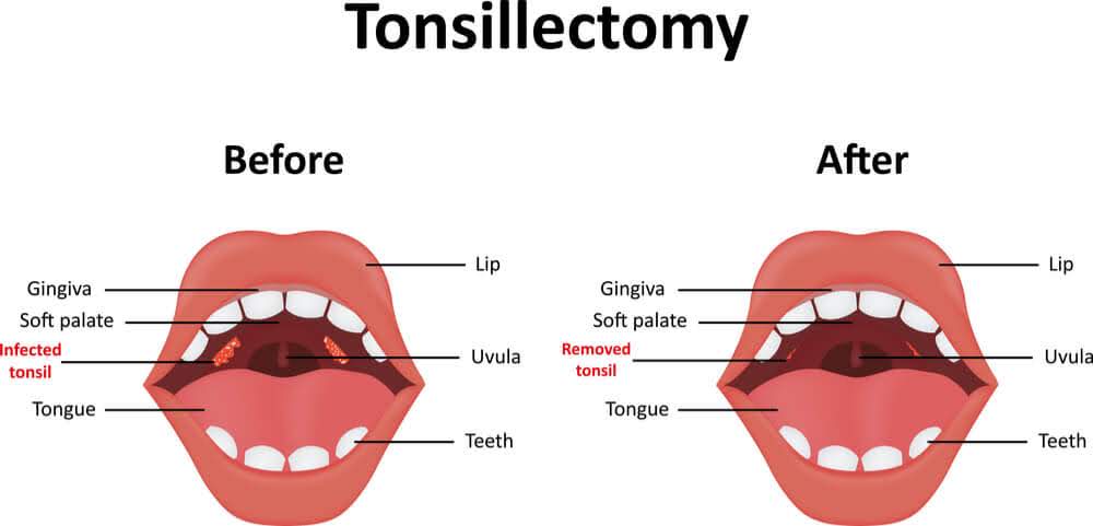 Human mouth anatomy before and after surgical removal of infected tonsils. The image also shows gingiva, uvula, teeth, soft palate, lips and teeth.