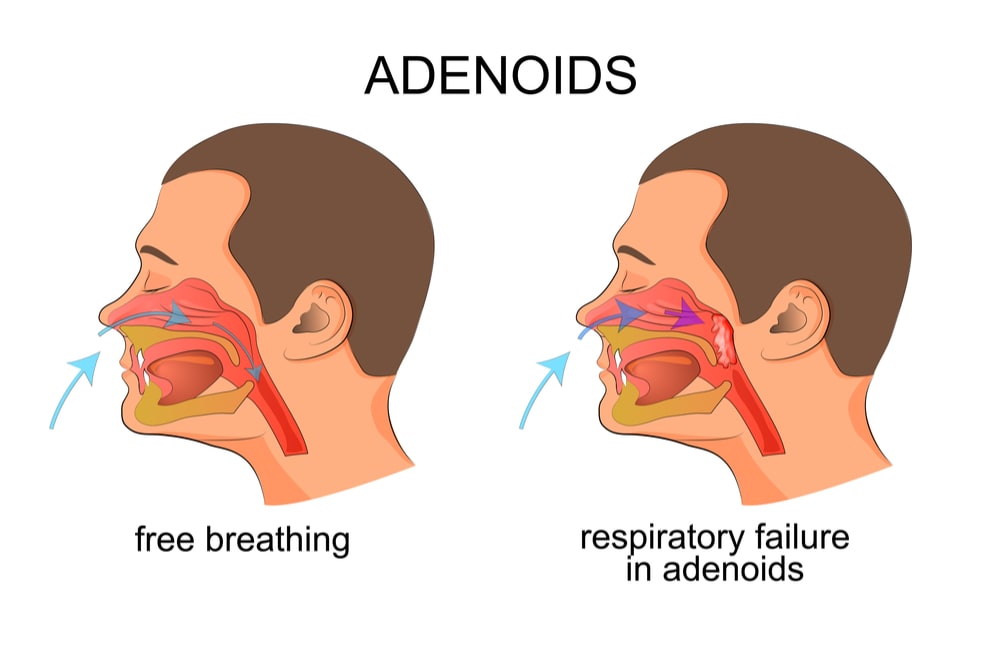 Image of a man breathing freely and then suffering from respiratory failure du to large adenoids