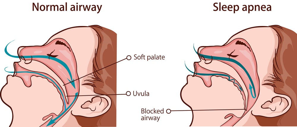 Image comparing a woman's free respiratory airways to her blocked airways. The obstruction leads to sleep apnea.