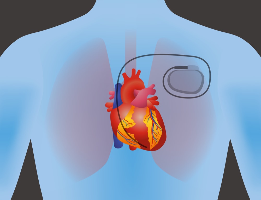 Image showing a heart with an implanted pacemaker