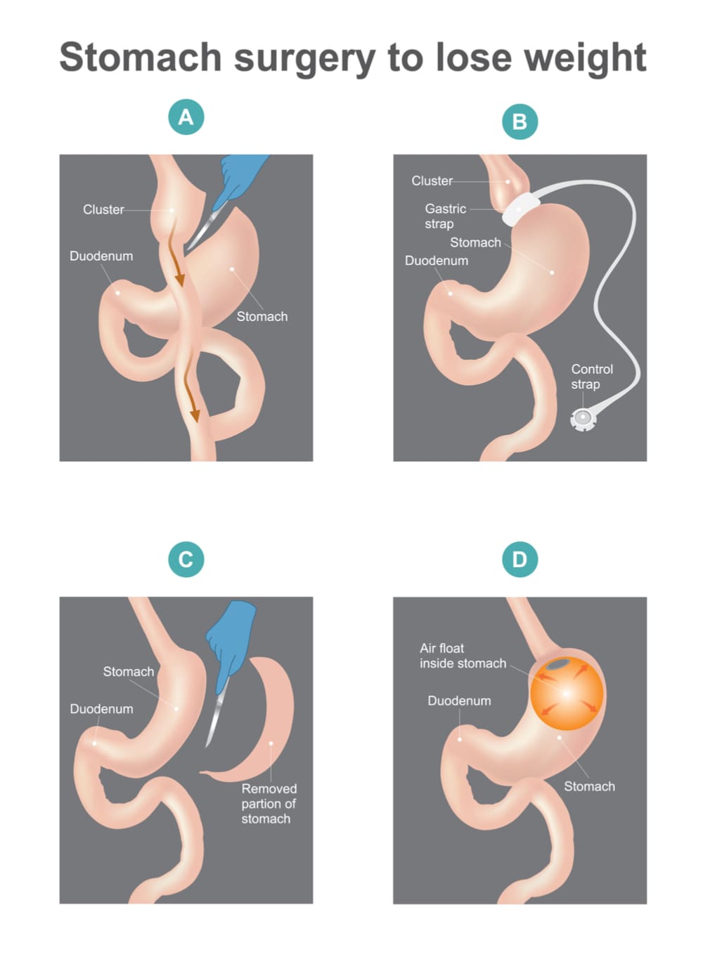 Different types of bariatric surgery procedures including sleeve gastrectomy, adjustable gastric banding, etc..