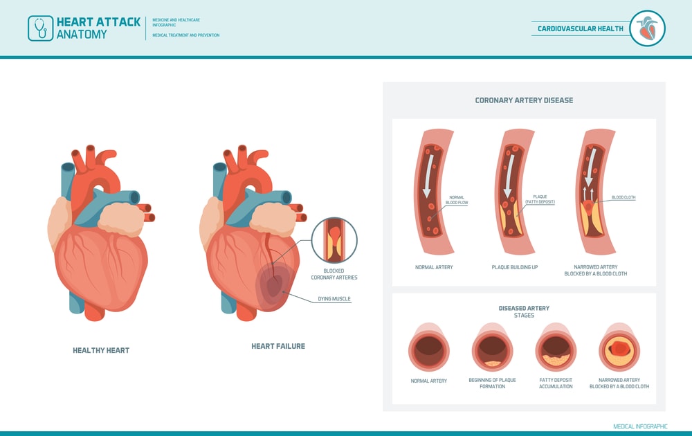 Heart failure due to atherosclerosis, blood vessel narrowing, and blockage.