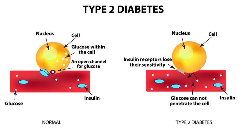 Image showing diabetes 2 at cellular level: cellular receptor to insulin loses its sensitivity and the channel for glucose uptake closes