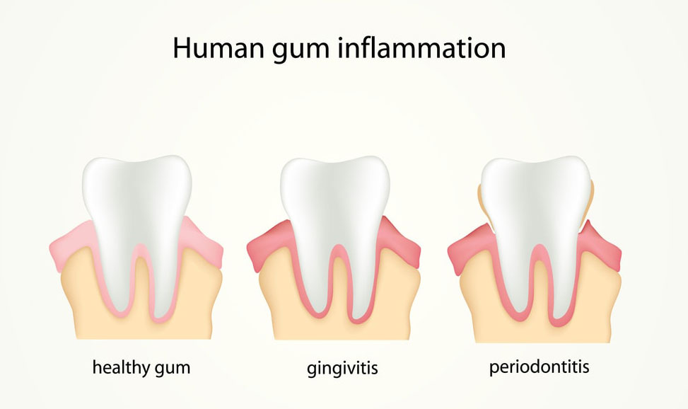 Different stages of human gum inflammation: healthy gum, gingivitis, periodontitis.