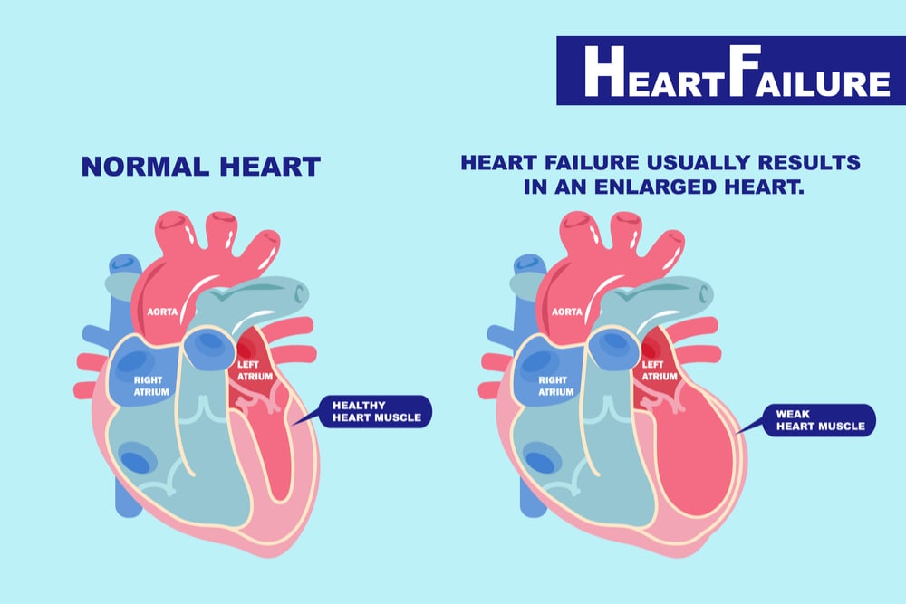 Image comparing a normal heart with healthy muscle to an enlarged heart with a weak muscle and thus prone to failure