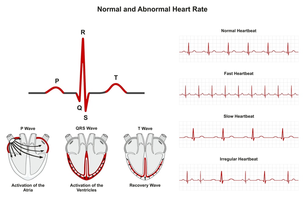 Normal and abnormal heart rates: activation of atria ventricle recovery wave; chart of normal, fast, slow, irregular heartbeats