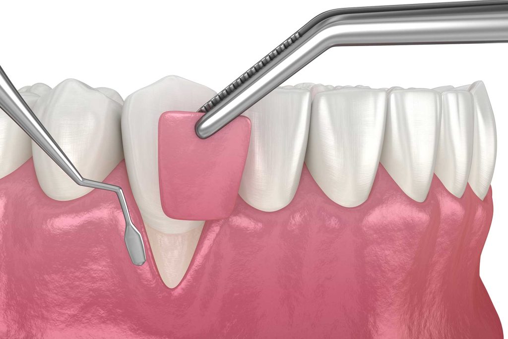 Gum graft and gum disease surgery