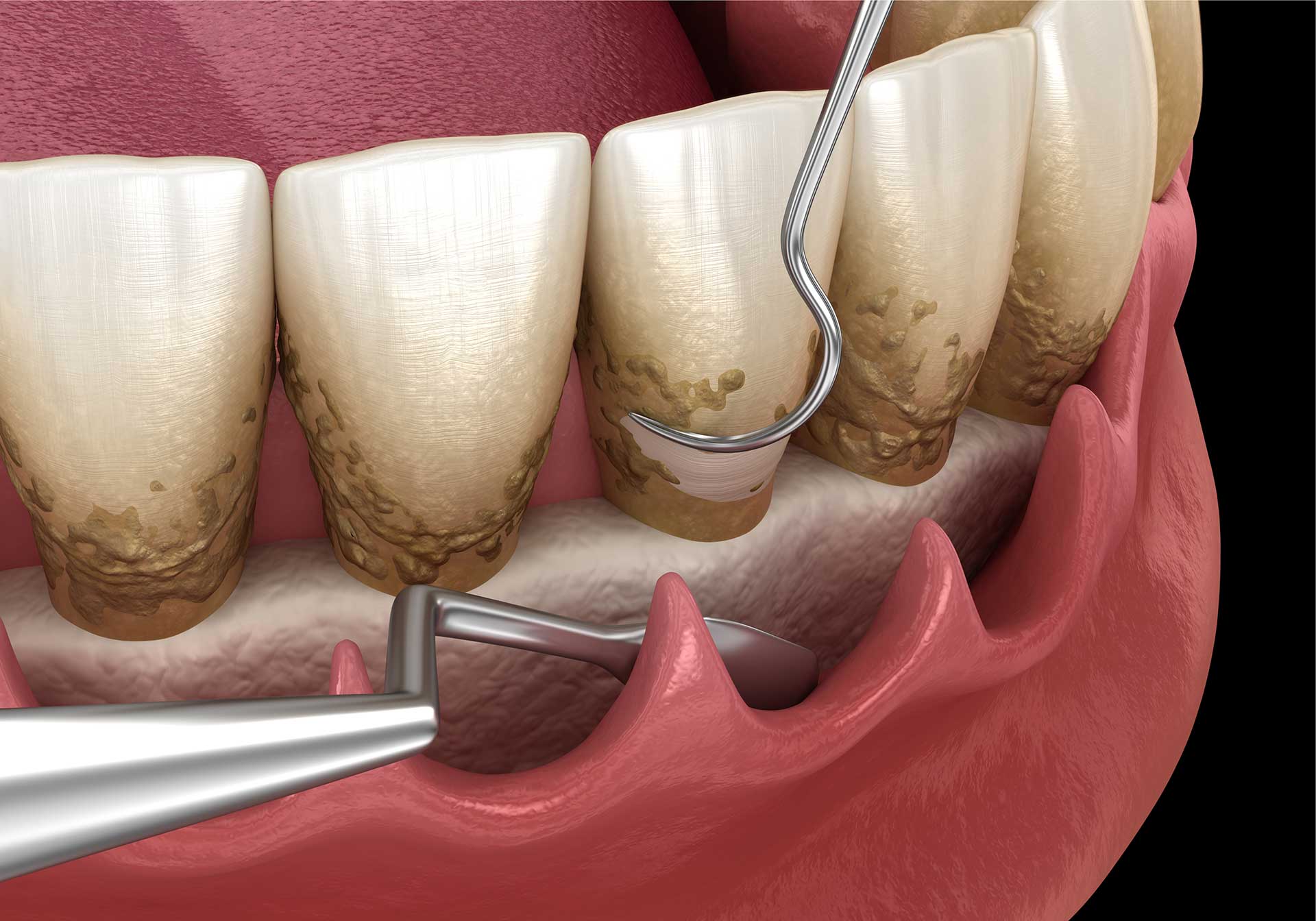 Dental deep cleaning: scaling and root planing