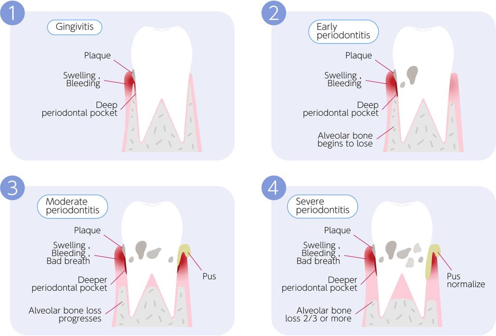 Stages of gum disease