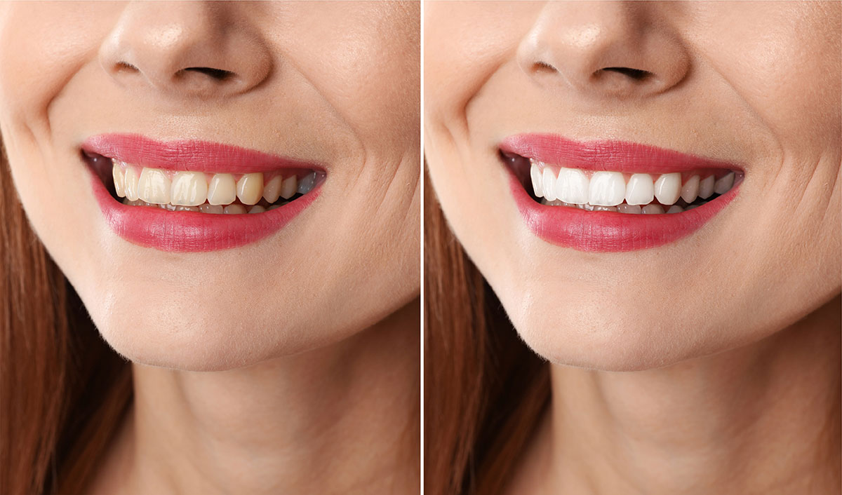 Zoom Teeth Whitening In NYC 1st Consultation Complimentary Teeth 