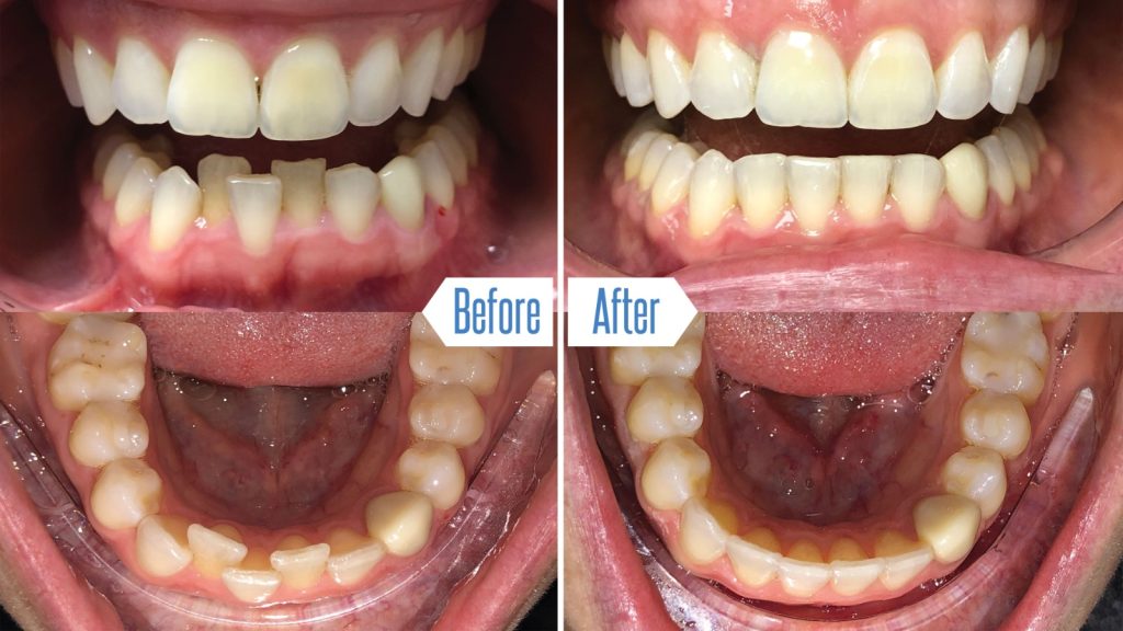 Invisalign before and after photos