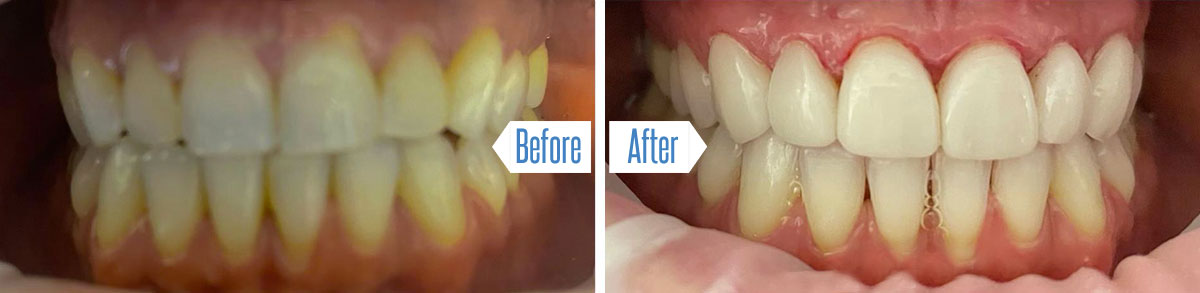 Porcelain Veneers: Before and After