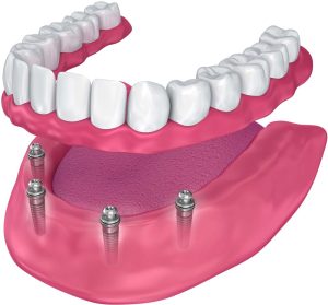 Snap on denture