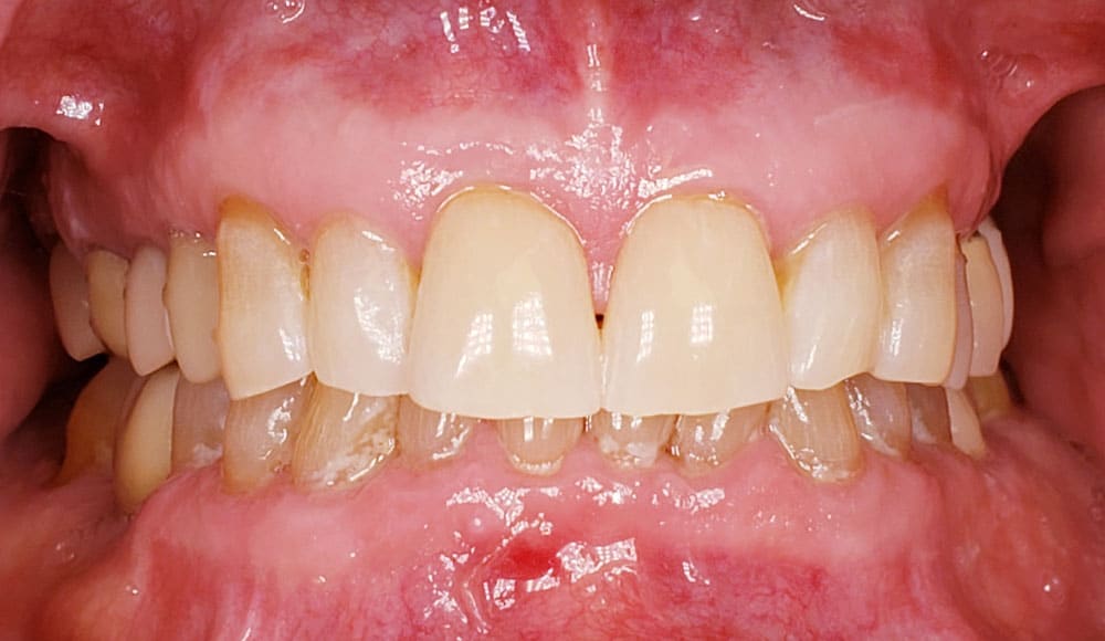 Open mouth showing full set of teeth after zoom teeth whitening