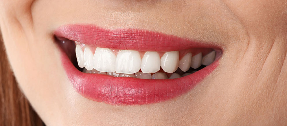 Woman smiling showing teeth after zoom teeth whitening