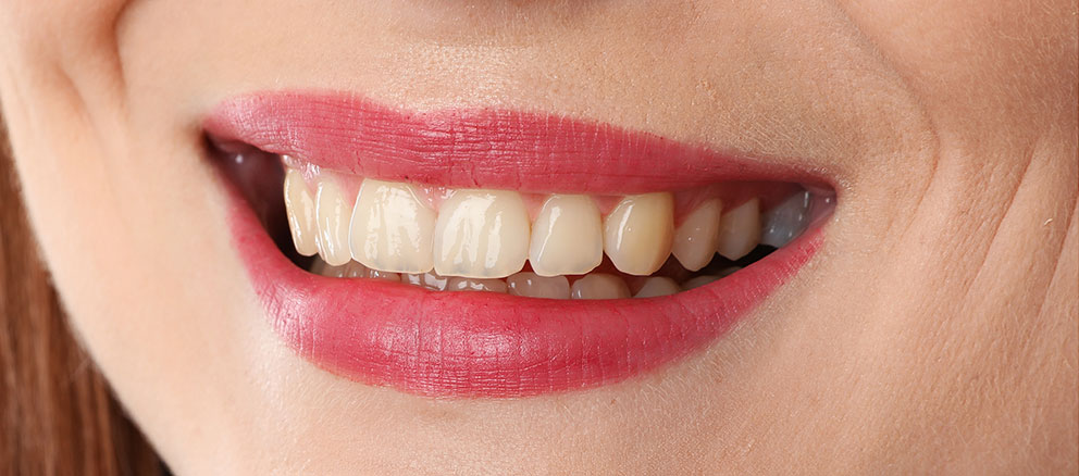 Woman smiling showing teeth before zoom teeth whitening