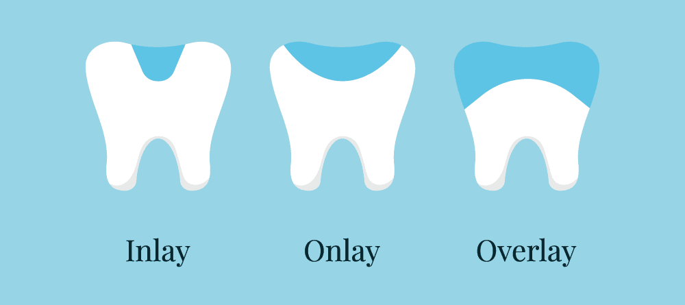 Three tooth illustrations showing an inlay, onlay and overlay.