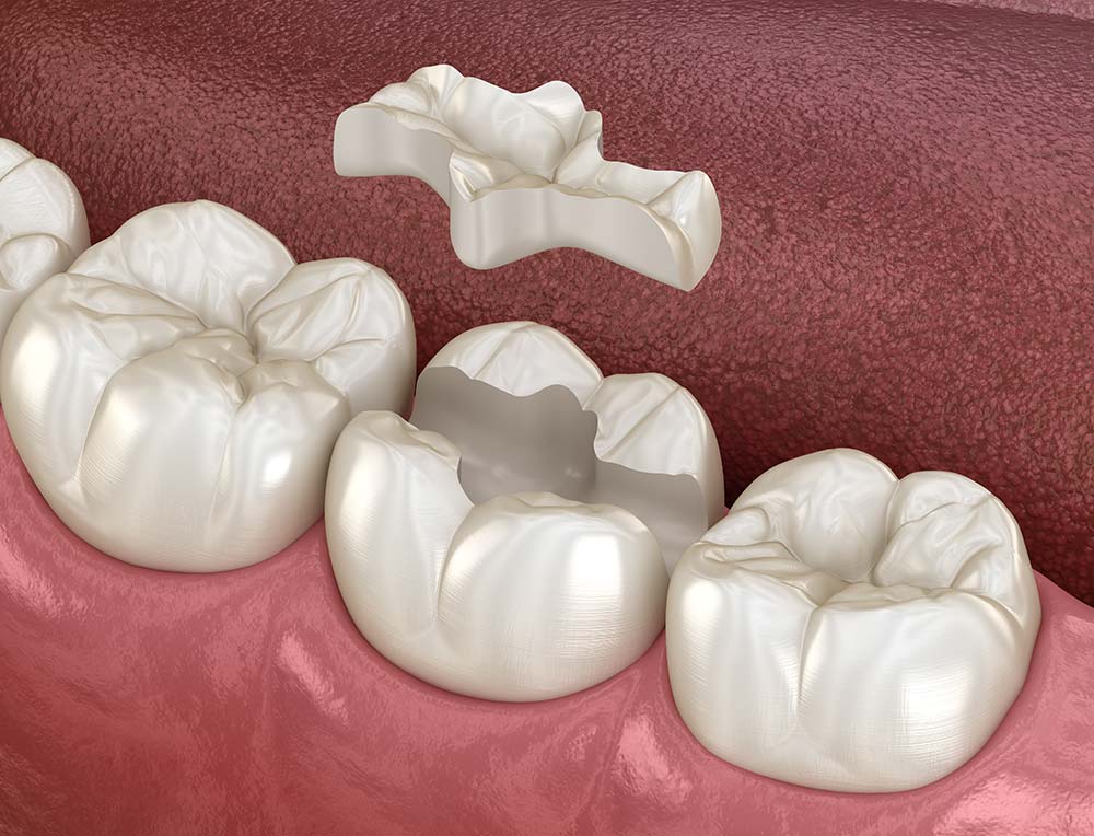 Close-up lower teeth with a piece removed to show porcelain inlays and onlays.