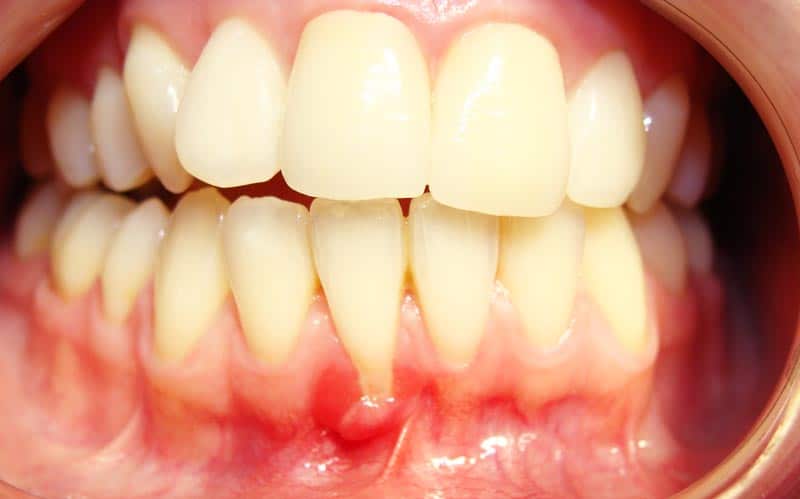 Full set of teeth showing receding gums before minimally invasive gum grafting.