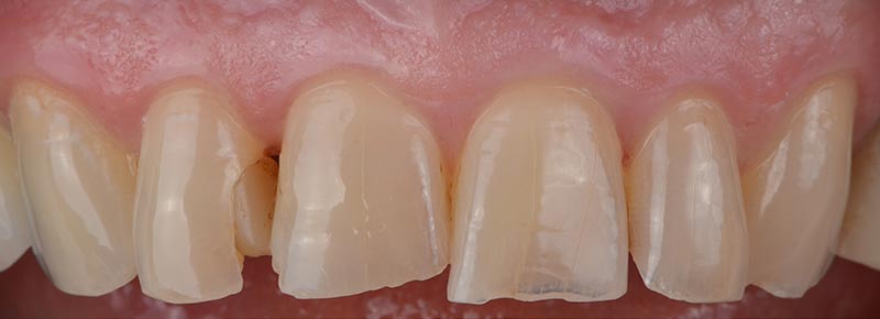 Upper teeth before dental makeover