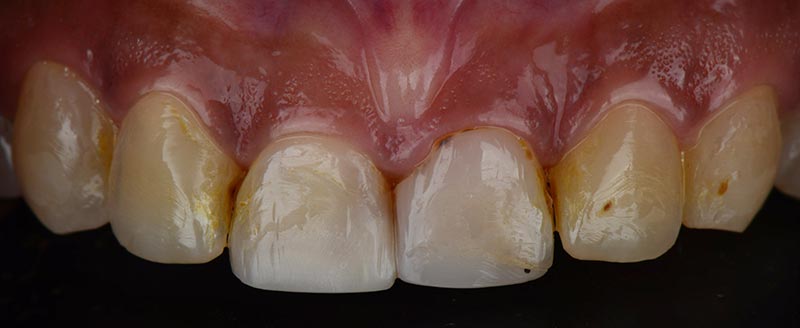 Upper yellow teeth with stains before dental makeover