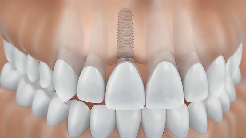 Dental implant with screw after implant surgery.