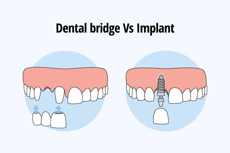 Dental bridge versus implant diagram.