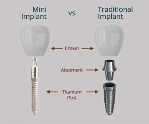 Mini traditional implants versus traditional implants diagram.